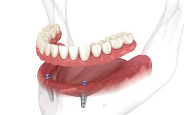 Günümüzde tam dişsizlik problemi yaşayan